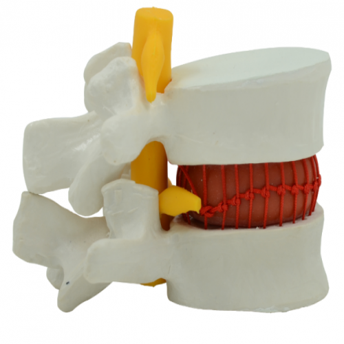 椎間盤突出模型（動態(tài)演示）